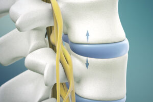 What is lumbar herniated disc icd 10