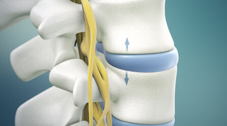 What is lumbar herniated disc icd 10
